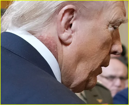 Pescoço de Donald Trump