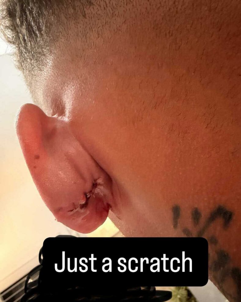 Kane Brown é atingido na cabeça por uma bola de golfe
