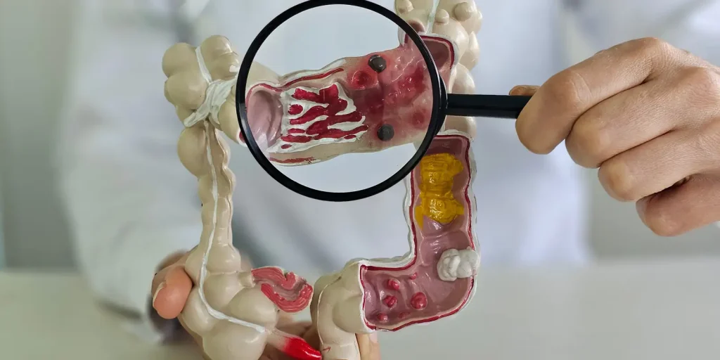 Doenças inflamatórias intestinais avançam cinco vezes em 13 anos e devem virar problema de saúde pública