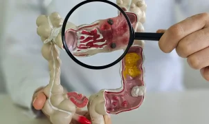Doenças inflamatórias intestinais avançam cinco vezes em 13 anos e devem virar problema de saúde pública