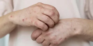 São Paulo confirma 36 casos de sarampo em 2026 e alerta para baixa vacinação