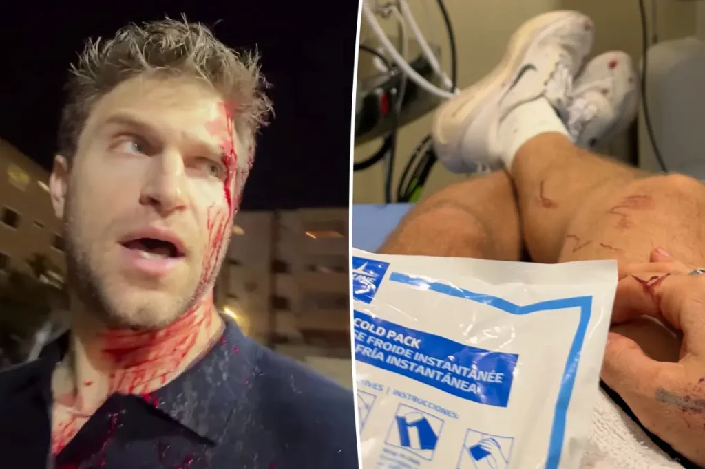 Keegan Allen relata recuperação após ser assaltado com violência em Los Angeles