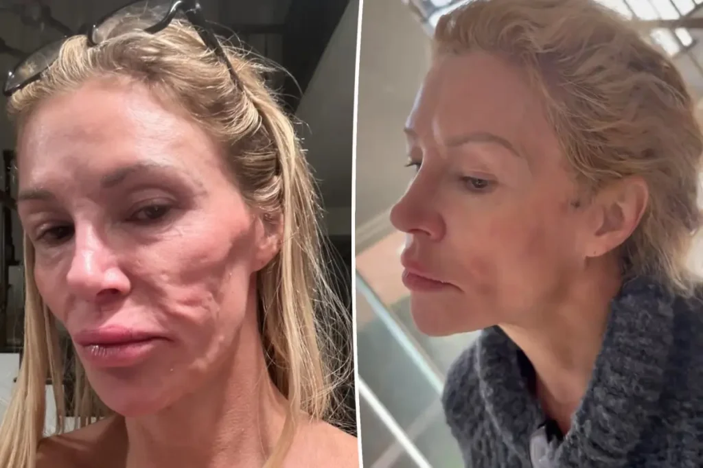 Brandi Glanville fará procedimento para remover parasita sob a pele do rosto