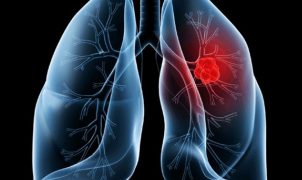 Papa Leão é operado após diagnóstico de adenocarcinoma pulmonar; entenda a doença