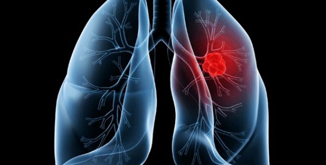 Papa Leão é operado após diagnóstico de adenocarcinoma pulmonar; entenda a doença