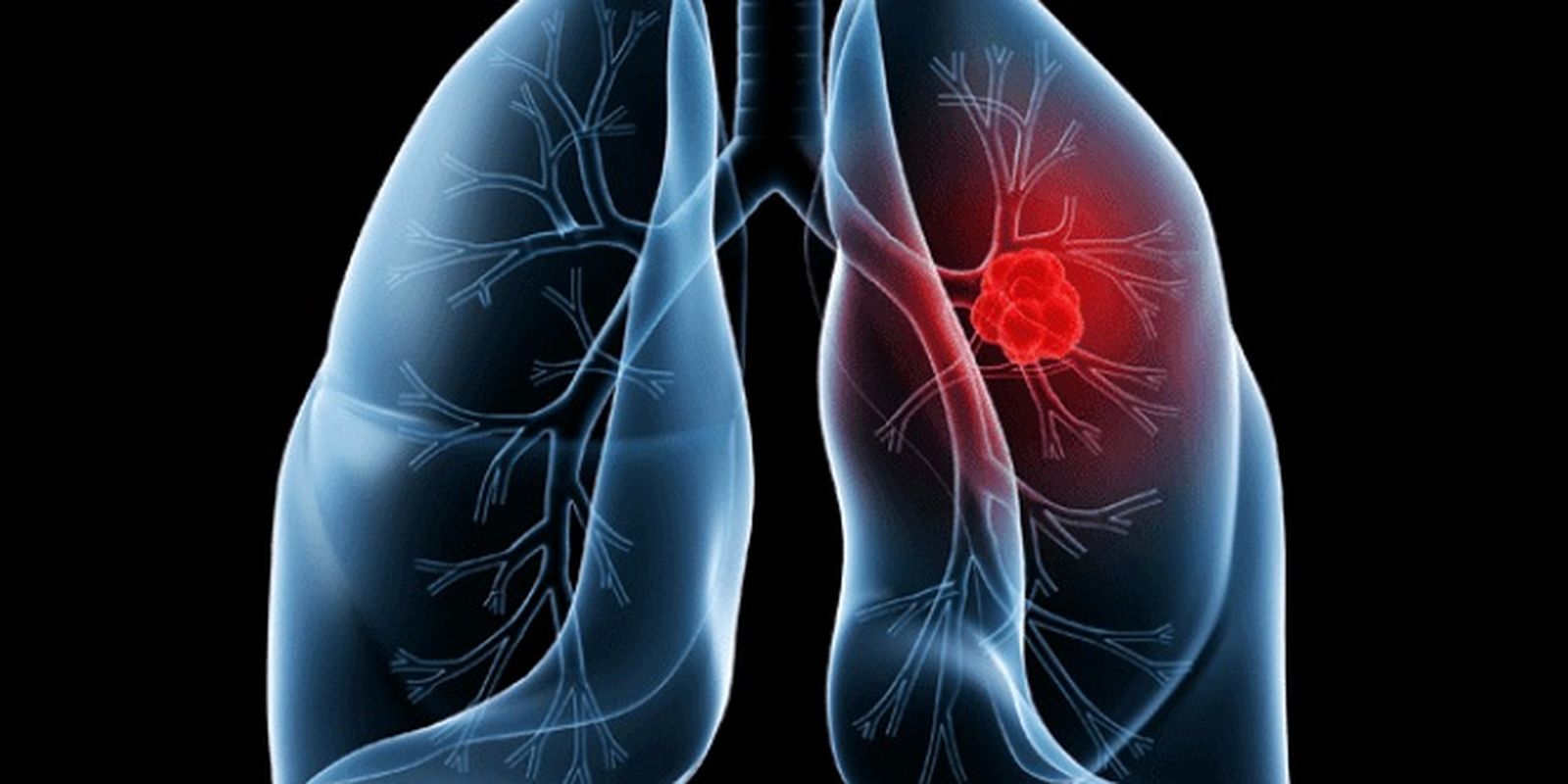 Papa Leão é operado após diagnóstico de adenocarcinoma pulmonar; entenda a doença